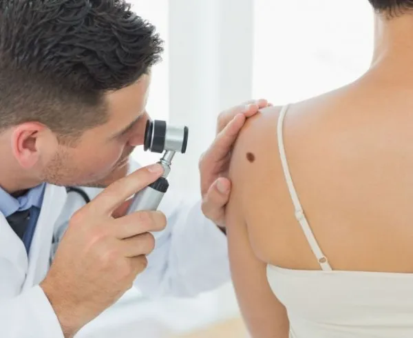 Până în 30 iunie îţi poţi testa aluniţele gratuit, la 7 medici din Braşov