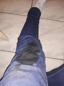 Vulpea de la Făgăraş, un nou episod: Un bărbat a fost muşcat