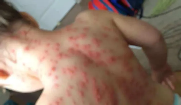 2 cazuri de rujeolă, la Brașov, săptămâna trecută