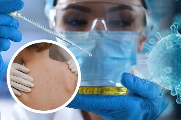 Variola maimuţei: autorităţile sanitare încep informările 