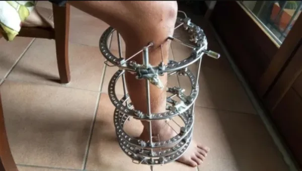 Înalt ca bradul…: Din ce în ce mai mulţi bărbaţi trec prin chinuri groaznice pentru a câştiga câţiva centimetri în înălţime