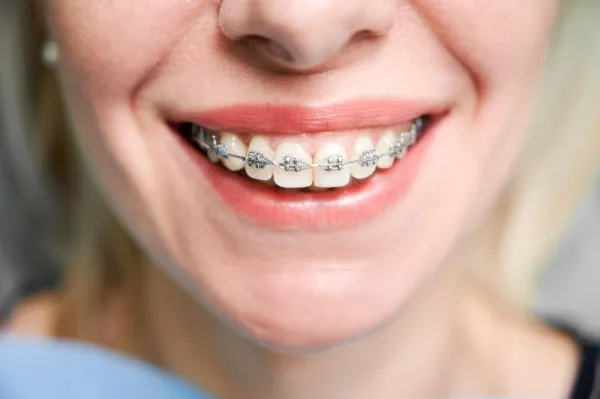 Ghidul pacientului cu aparat dentar: la ce să te aștepți în timpul tratamentului ortodontic