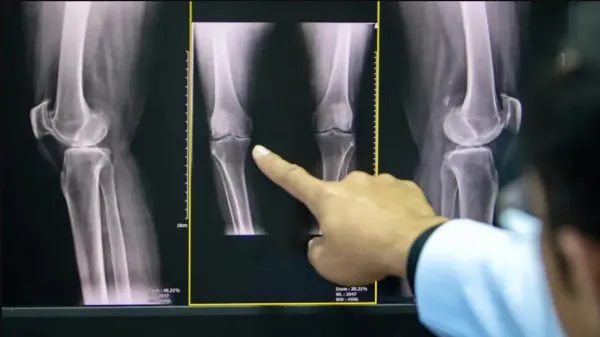 Artroza, boala care afectează în principal femeile, poate fi tratată chirurgical