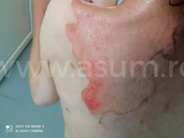 Arsă joi, internată vineri, anchetă abia de sâmbătă