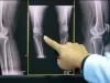 Artroza, boala care afectează în principal femeile, poate fi tratată chirurgical