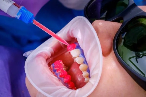 Albire Dentară cu Laser la Clinica Life Dental Spa